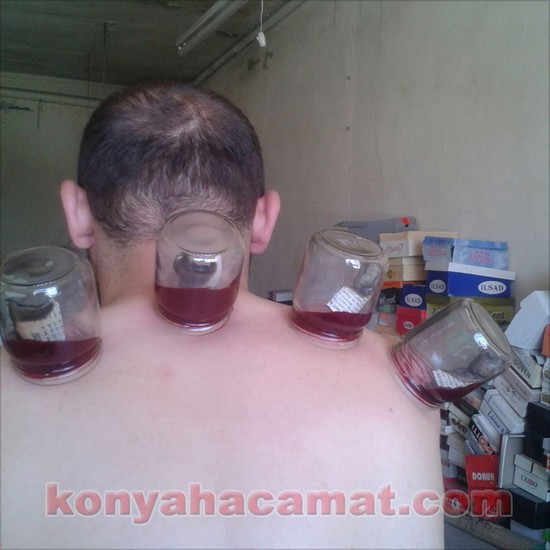 KONYA HACAMAT hacamat tedavisi Konya